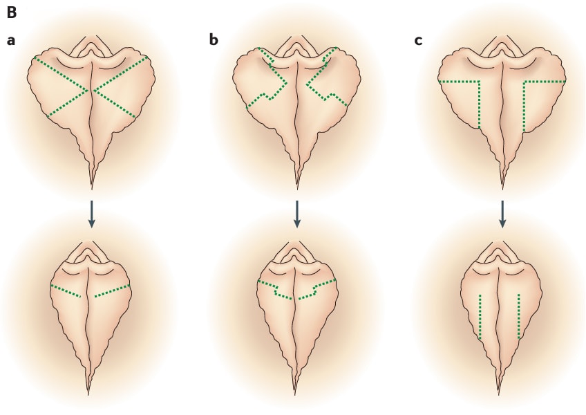 Spôsob operácie vaginoplastiky – obrázok B